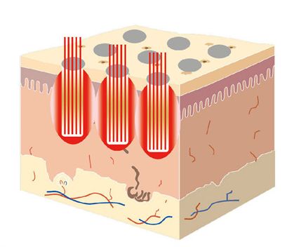 CO2 fractional laser reconstruction and treatment of the skin
