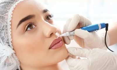Laser freckle removal